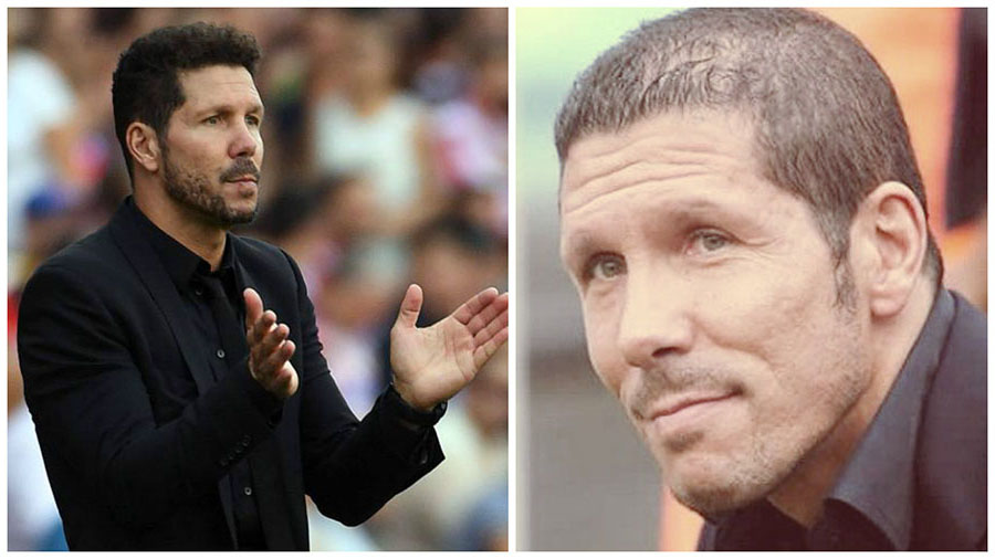 El de Simeone ha sido uno de los casos de famosos con injerto de pelo más comentados.