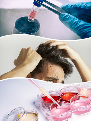 El plasma enriquecido para evitar la alopecia en Málaga proporciona numerosas ventajas a sus usuarios.