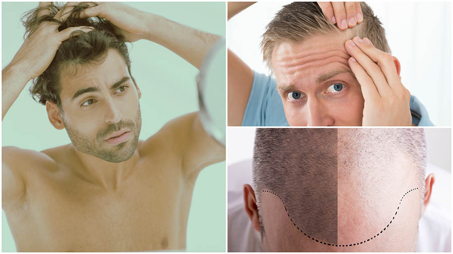 En Estambul hay algunos de los mejores cirujanos especializados en trasplante capilar en Turquía.