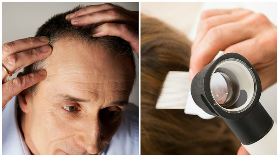 Los resultados del implante capilar son naturales y permanentes.