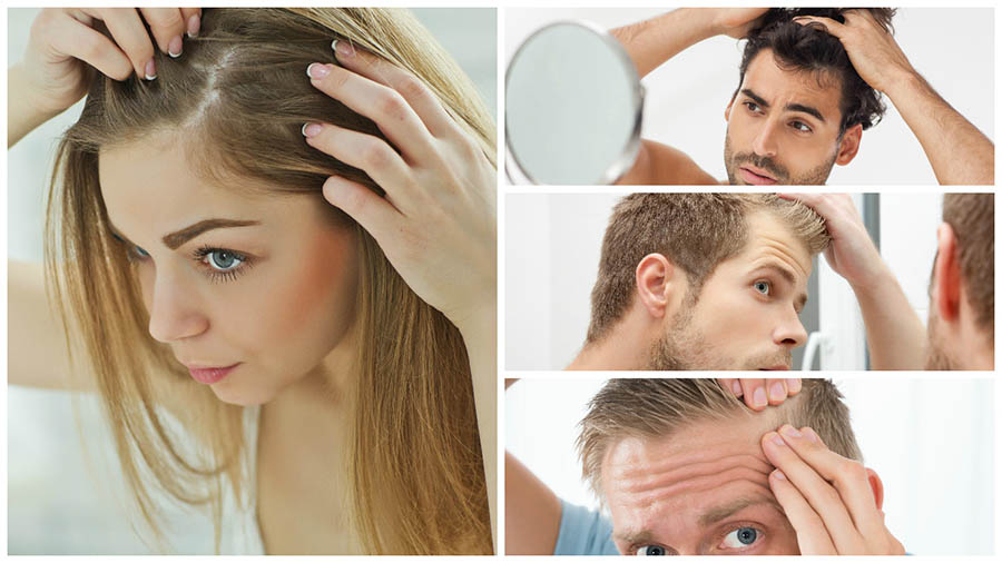 La caída del pelo puede afectar tanto a hombres como a mujeres.